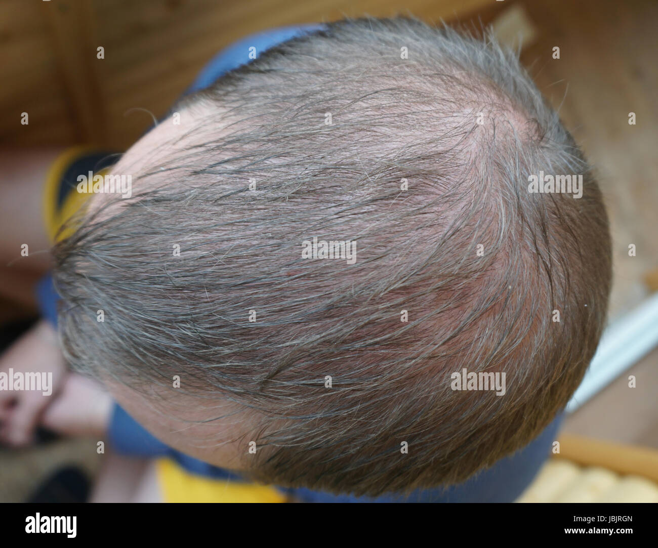 Male Head With Thinning Hair Or Alopecia Stock Photo 144857797