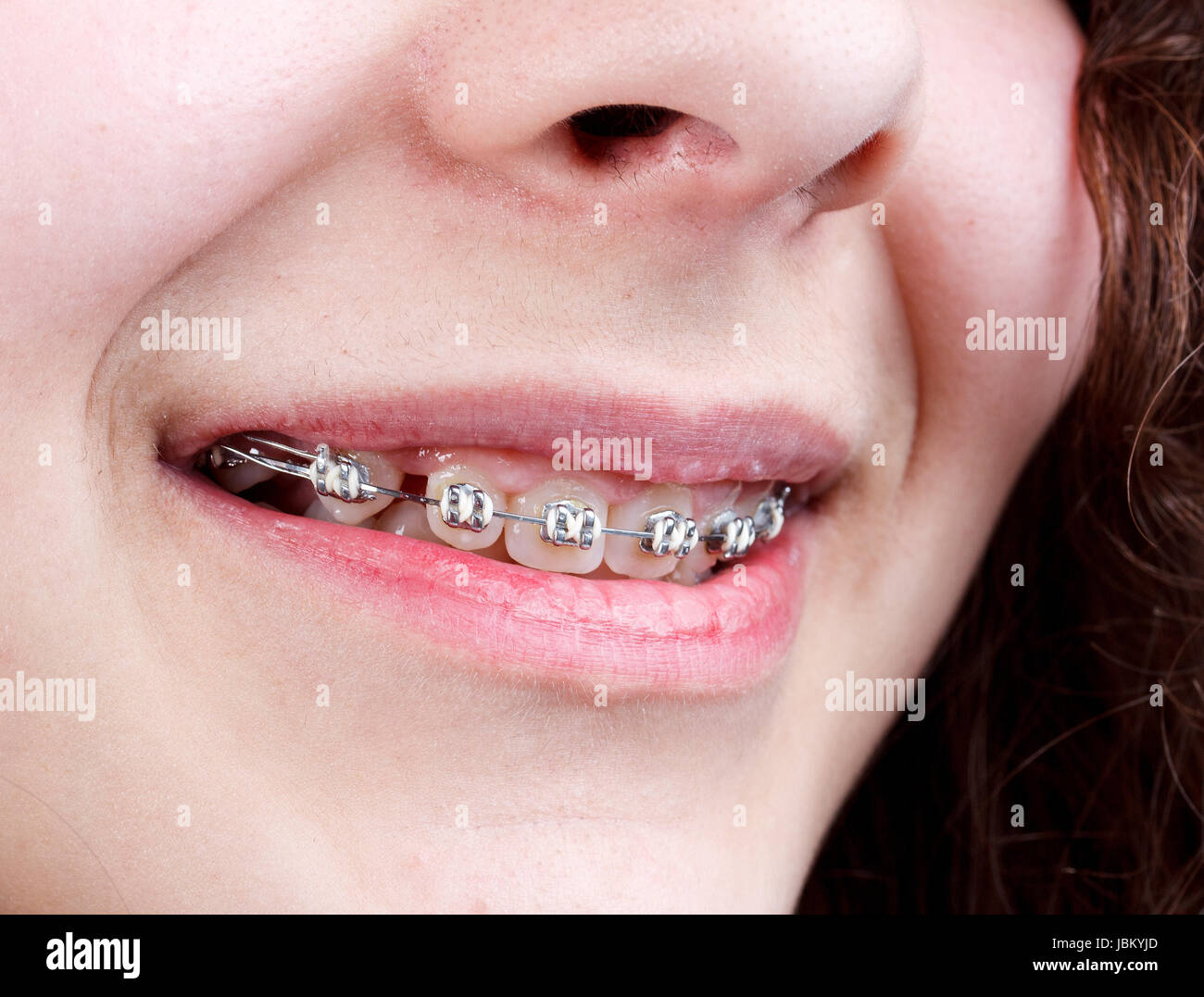 Young woman with brackets on teeth, close up shot Stock Photo