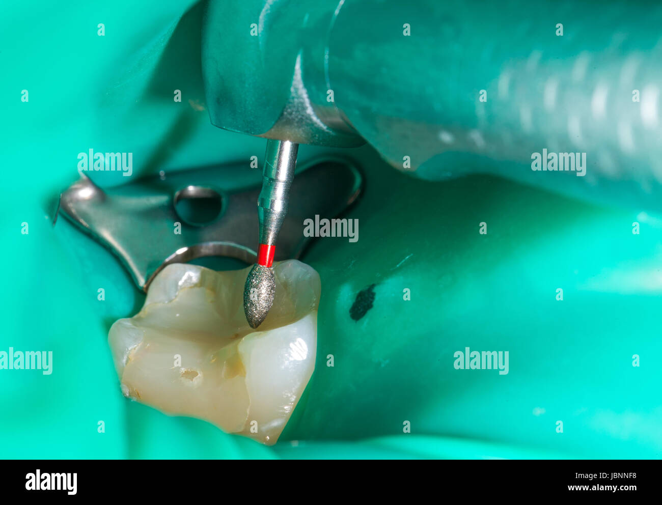Close up picture of an endodontic procedure on a human tooth Stock