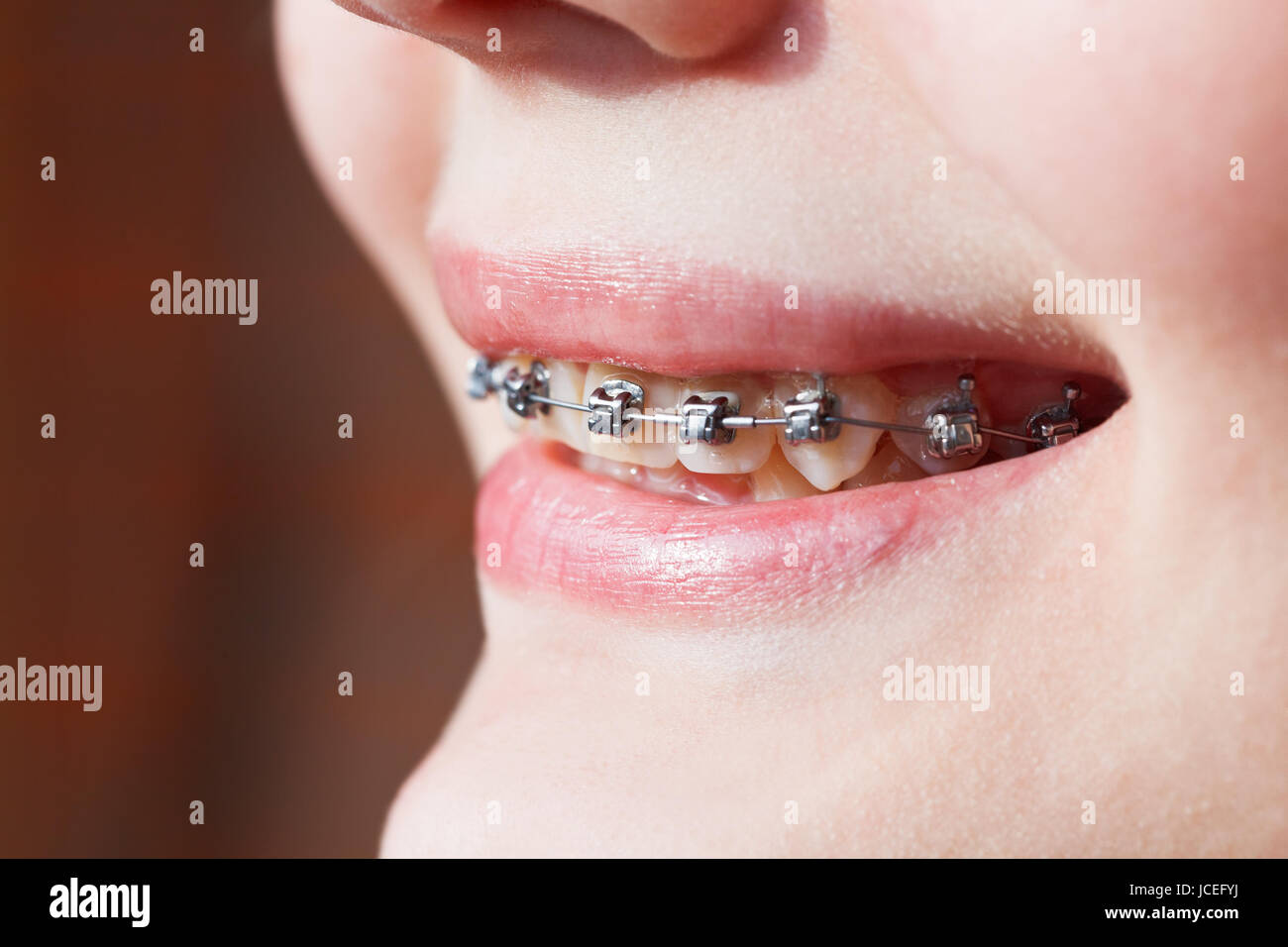 side view of dental braces on teeth of upper jaw before Orthodontic