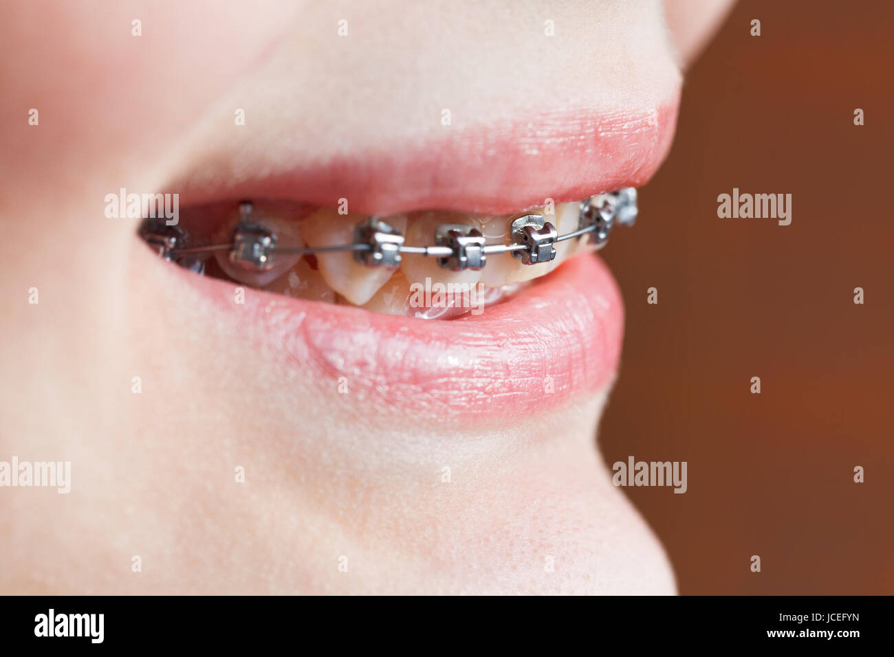dental braces on teeth of upper jaw close up before Orthodontic ...