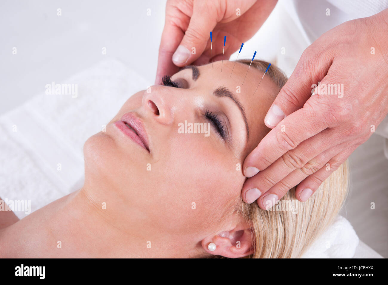 Detail Of A Woman Receiving An Acupuncture Needle Therapy Stock Photo