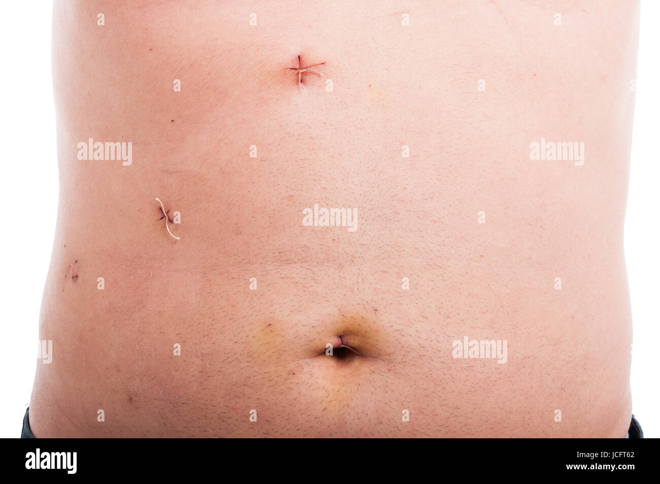 Male abdomen with fresh stitches after gallbladder removal and laparoscopic surgery Stock Photo
