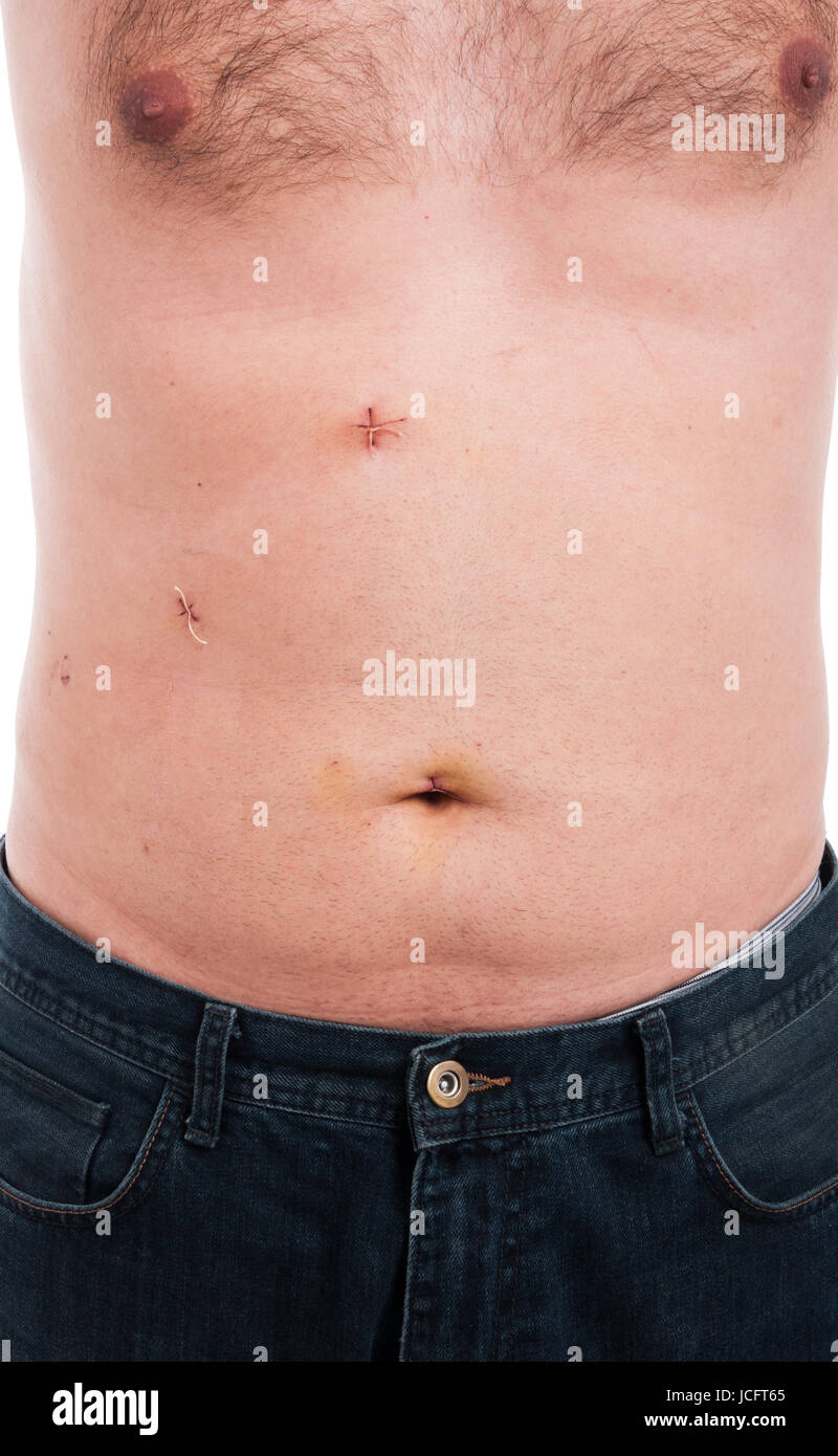 Male abdomen with stitches after gallbladder removal and laparoscopic surgery Stock Photo