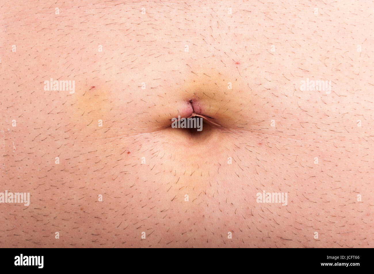 Closeup of belly stitch after laparoscopic surgery of gallbladder removal Stock Photo