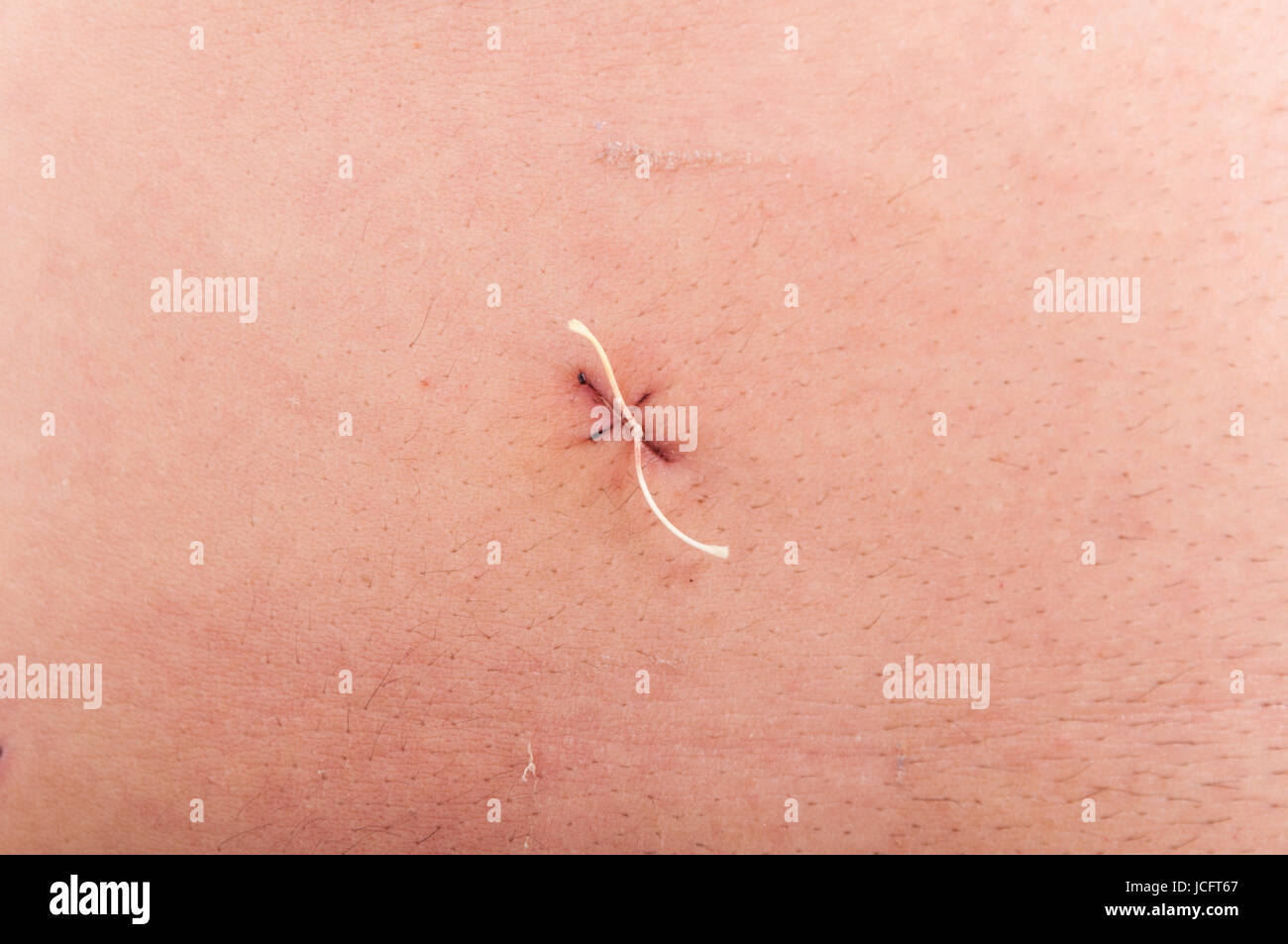 Closeup of abdominal stitch after laparoscopic surgery of gallbladder removal Stock Photo