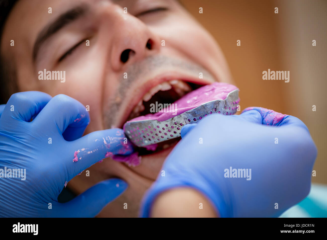 Dentist using dental impression for braces to the male patient. Close