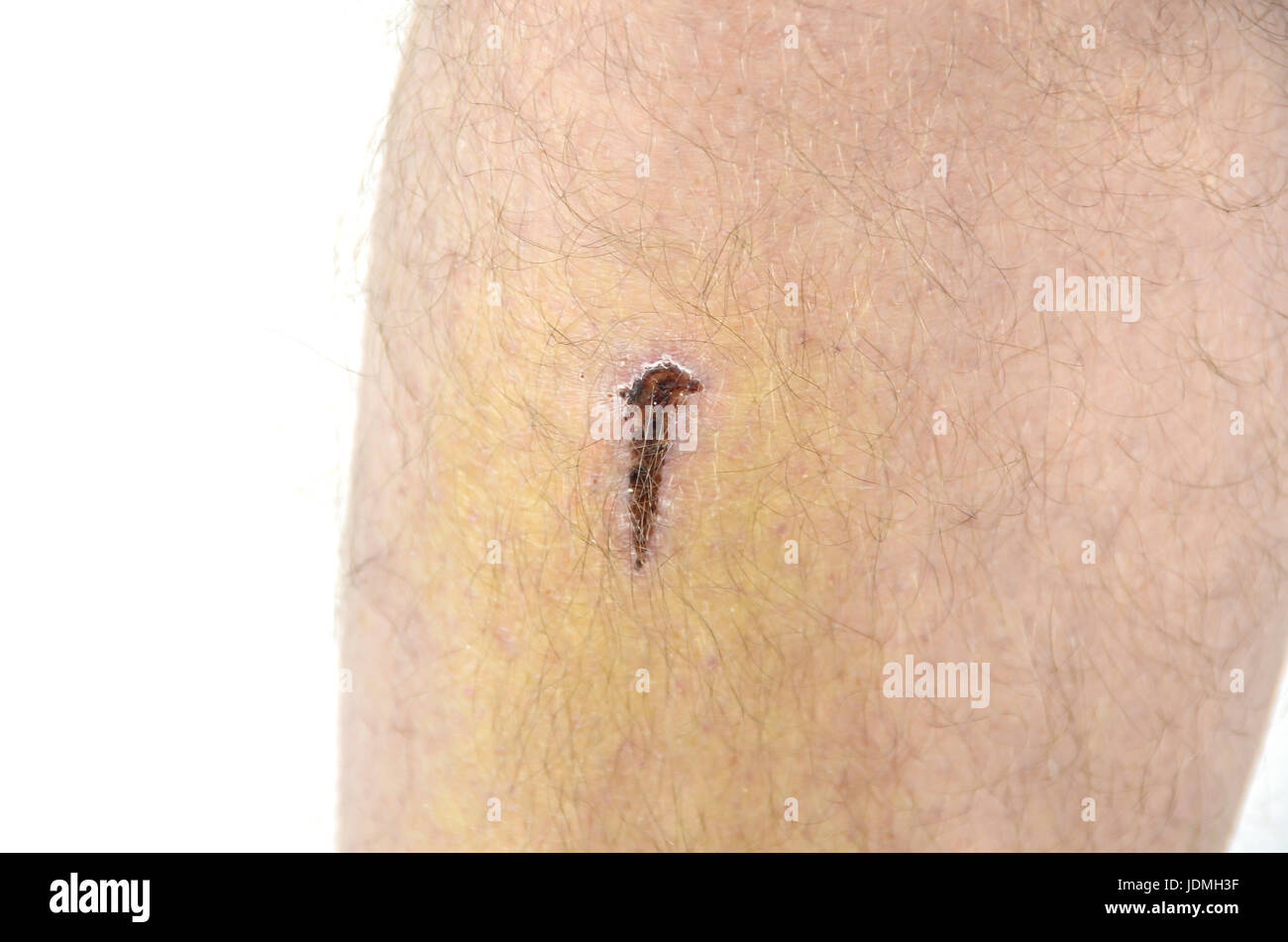 Scraped knees, wound on tibia Stock Photo