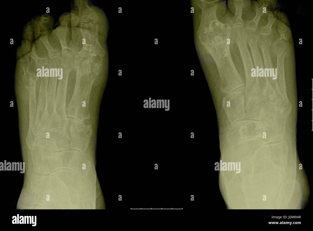Arthritis Feet High Resolution Stock Photography and Images Alamy