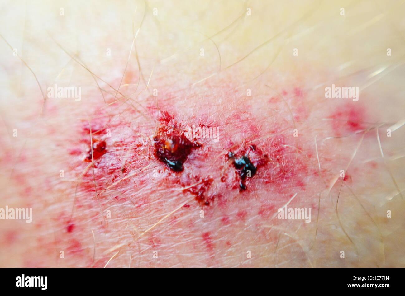 Skin Abrasion High Resolution Stock Photography and Images Alamy