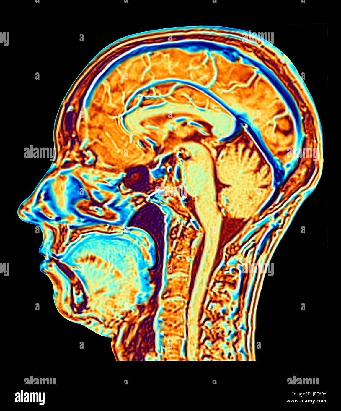 Computer enhanced false-colour Magnetic Resonance Image (MRI) of a mid-sagittal section through the head of a normal 46 year-old woman, showing structures of the brain, spine & facial tissues. Profiled features of the main part of the brain include the convoluted surface of the cerebral cortex, the corpus callosum, pons & medulla, structures of the brainstem, which are continuous with the spinal cord. The cerebellum, the centre of balance & coordination, lies to the right of the brainstem. Stock Photo