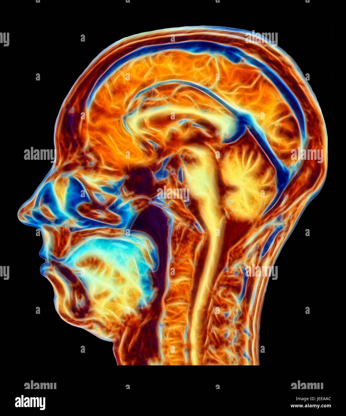 Computer enhanced false-colour Magnetic Resonance Image (MRI) of a mid-sagittal section through the head of a normal 46 year-old woman, showing structures of the brain, spine & facial tissues. Profiled features of the main part of the brain include the convoluted surface of the cerebral cortex, the corpus callosum, pons & medulla, structures of the brainstem, which are continuous with the spinal cord. The cerebellum, the centre of balance & coordination, lies to the right of the brainstem. Stock Photo