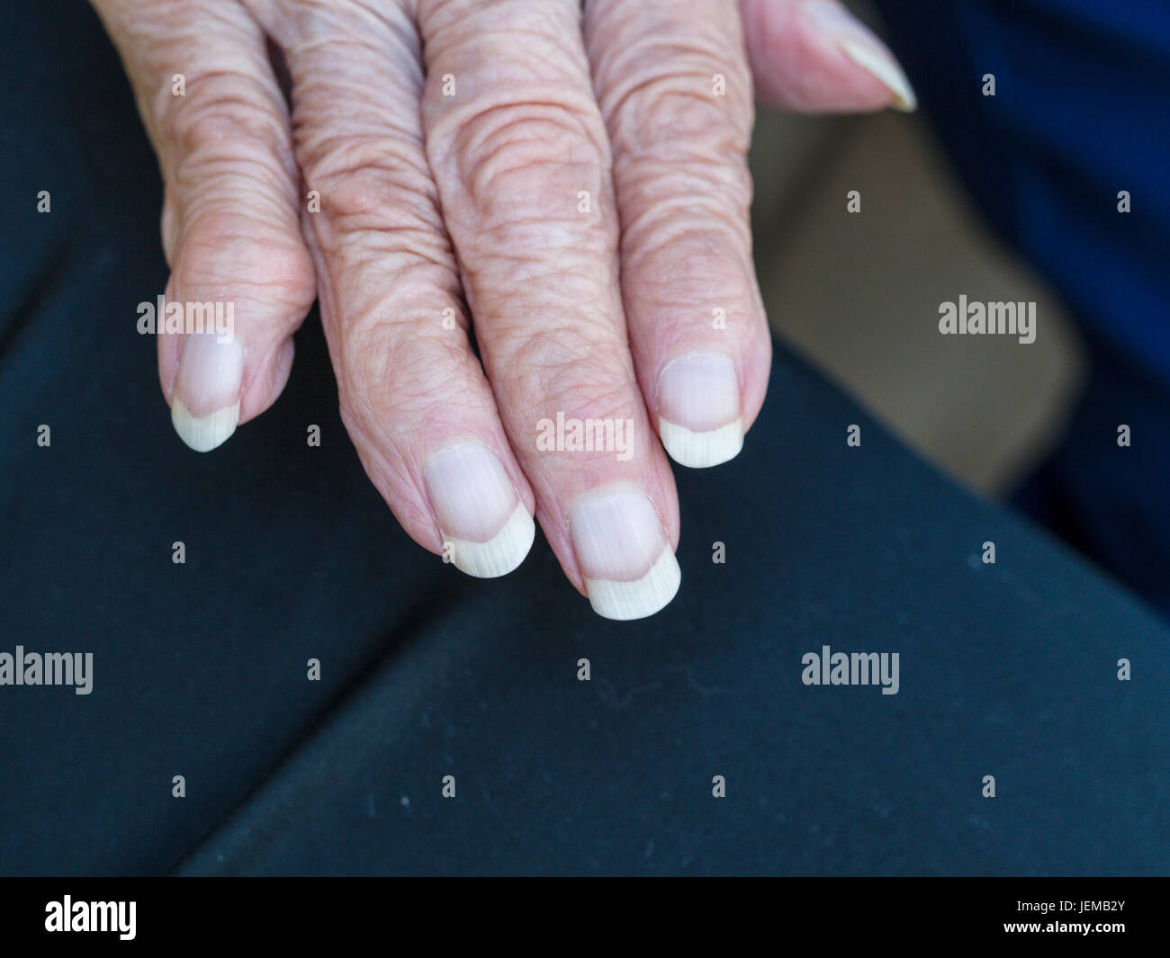 Arthritic wrinkled hand of an eldery woman: The right hand with long nails and misshapen fingers of an old woman. Stock Photo