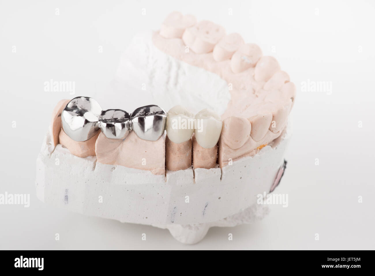 Bridged dental prostheses are made of steel and ceramic paste Stock Photo