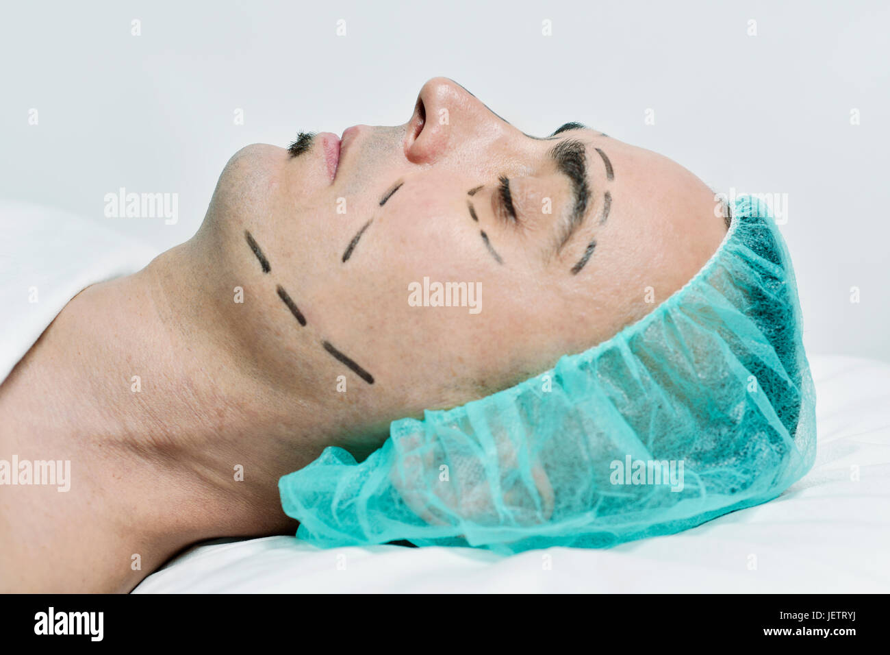 closeup of the head of a young caucasian man who is about to have a plastic surgery, with a medical disposable cap and with surgery lines marked aroun Stock Photo