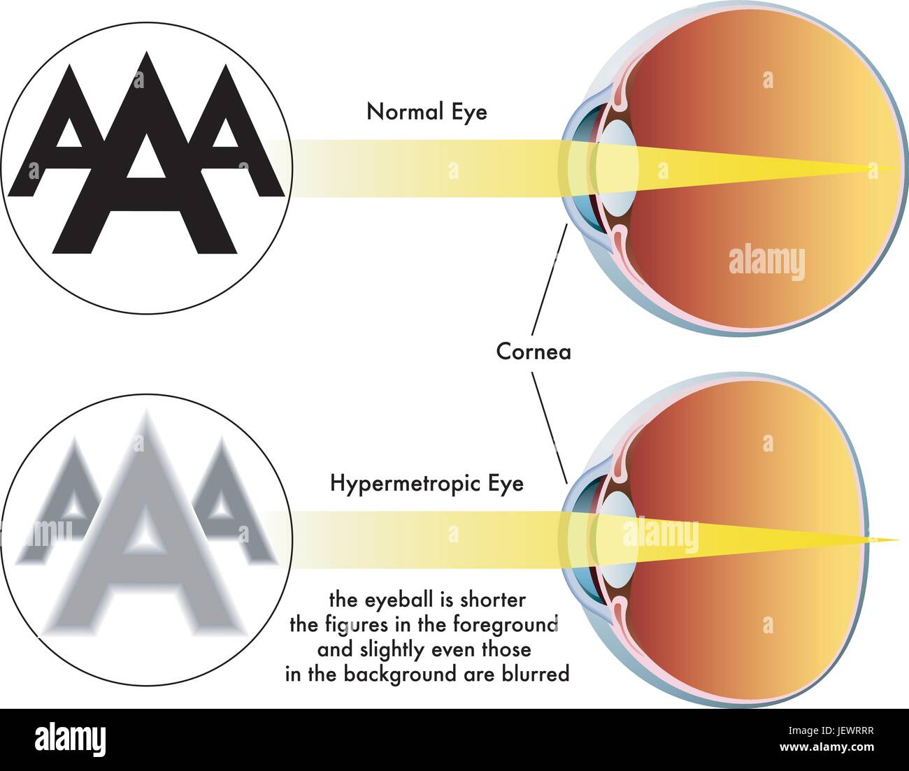 Eyeglasses hyperopic Stock Vector Images - Alamy