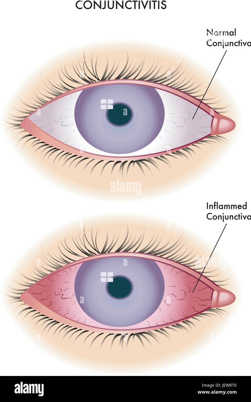 Conjunctival sac hi-res stock photography and images - Alamy