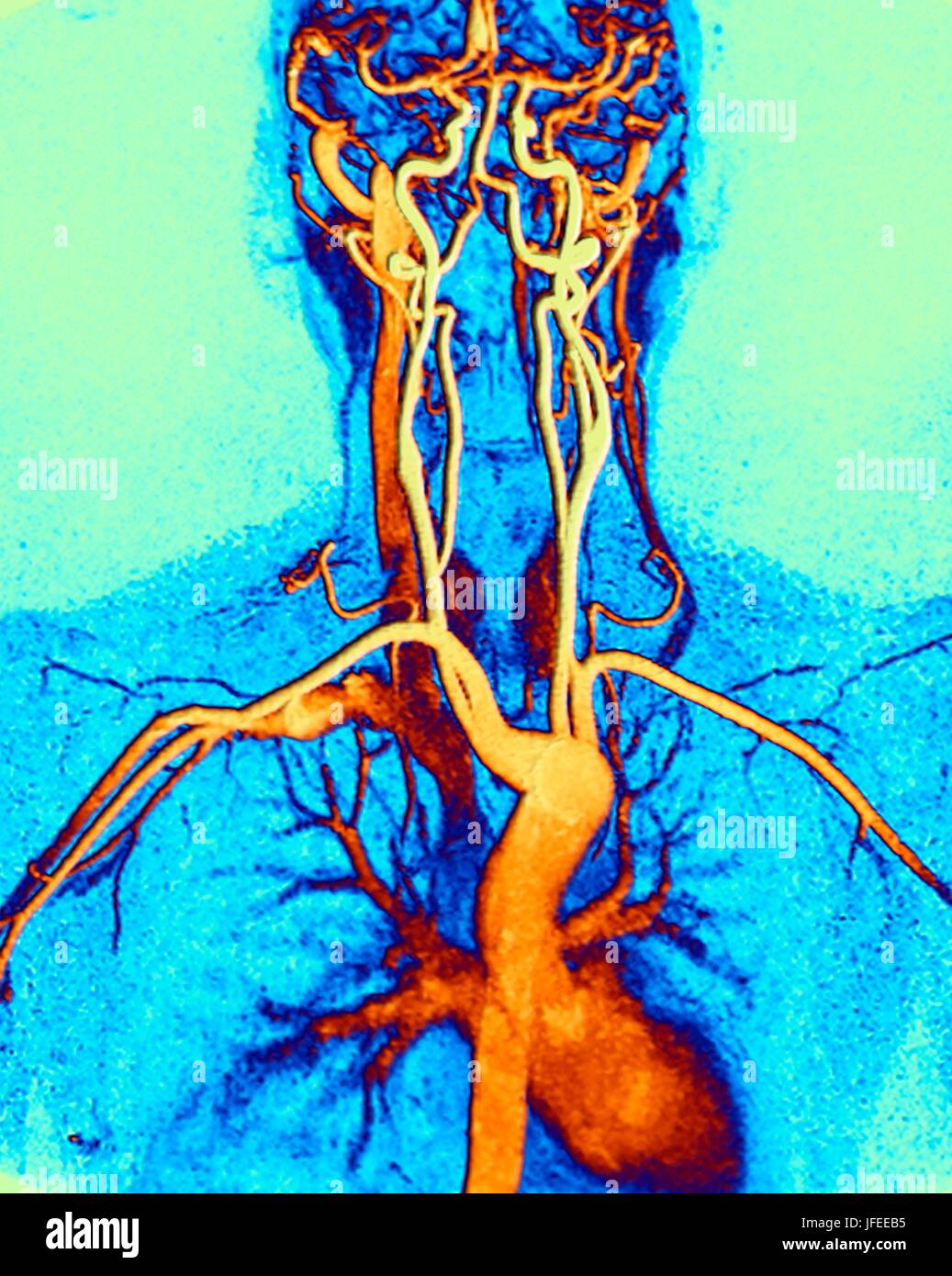 Chest, neck and head arteries. Coloured magnetic resonance angiography (MRA) scan of a normal carotid system of a 45 year old female. Bottom centre is the aortic arch, which curves over the heart. The arteries that branch off from these are: the brachiocephalic artery (left), the left common carotid artery (centre) and the left subclavian artery (right). The brachiocephalic artery splits again into the right common carotid and right subclavian arteries. The right and left common carotid arteries supply the neck and the right and left subclavian arteries supply the arms. MRA is a non-invasive Stock Photo