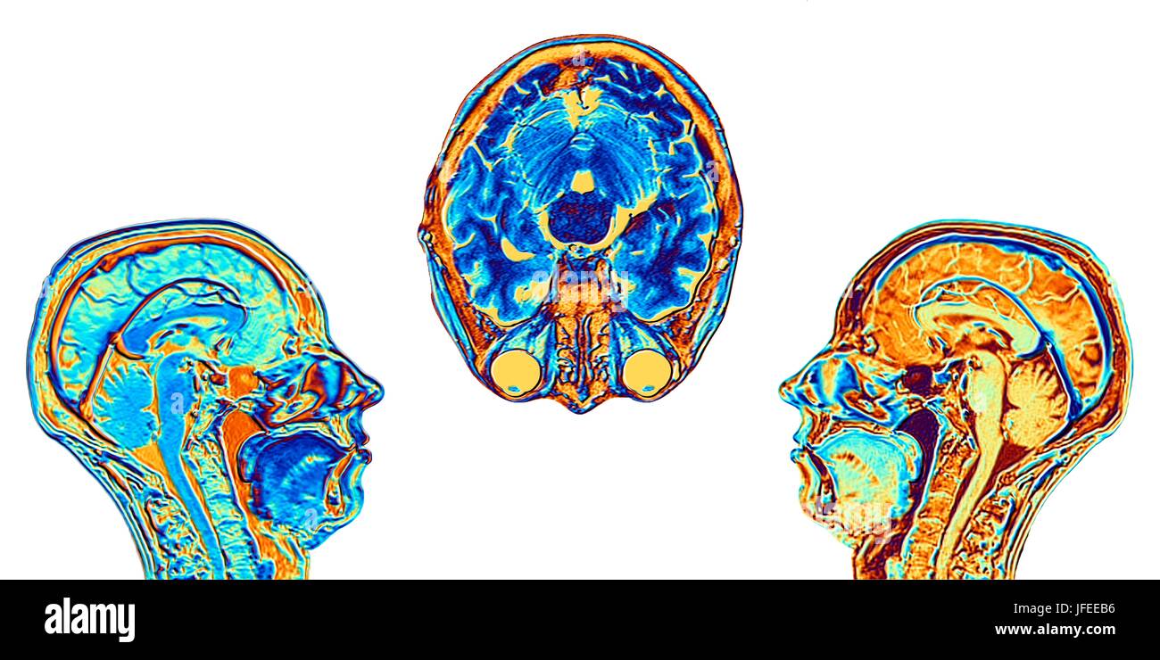 Mri Scans Showing Showing Normal Anatomy High Resolution Stock ...
