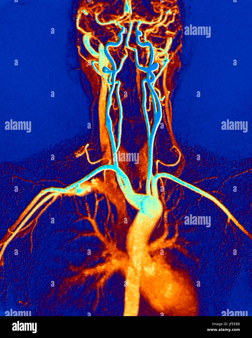 Chest, neck and head arteries. Coloured magnetic resonance angiography (MRA) scan of a normal carotid system of a 45 year old female. Bottom centre is the aortic arch, which curves over the heart. The arteries that branch off from these are: the brachiocephalic artery (left), the left common carotid artery (centre) and the left subclavian artery (right). The brachiocephalic artery splits again into the right common carotid and right subclavian arteries. The right and left common carotid arteries supply the neck and the right and left subclavian arteries supply the arms. MRA is a non-invasive Stock Photo