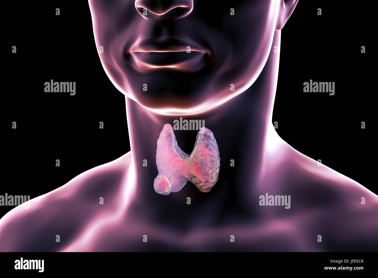 Thyroid gland tumour, computer illustration. Stock Photo
