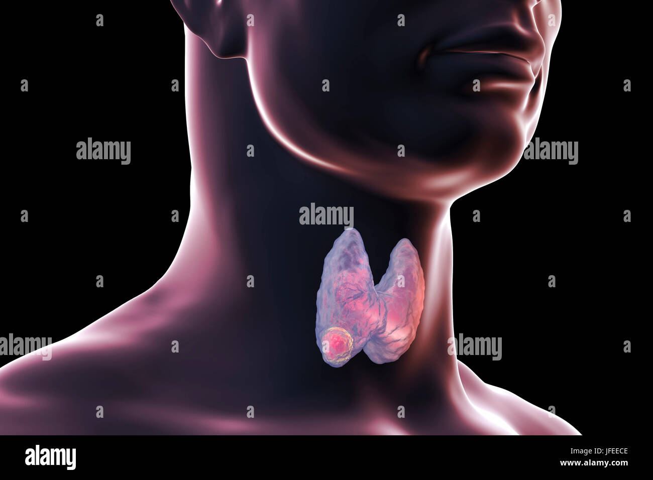 Thyroid gland tumour, computer illustration. Stock Photo