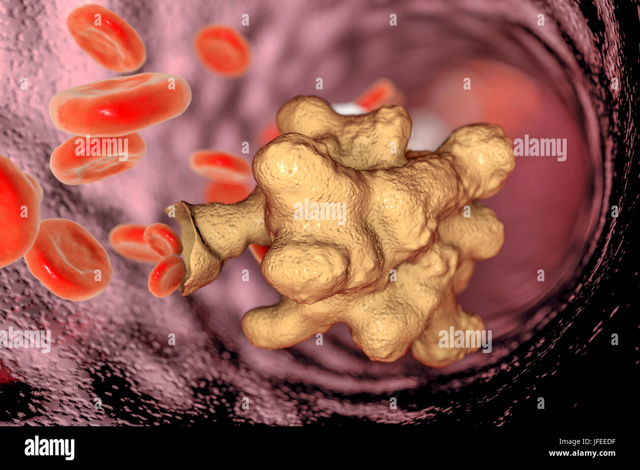 Parasitic amoeba (Entamoeba histolytica) in a blood vessel, computer illustration. This single-celled organism causes amoebic dysentery and ulcers (vegetative trophozoite stage). It is spread by faecal contamination of food and water and is most common where sanitation is poor. Amoebae invade the intestine but may spread to the liver, lungs and other tissues. Infection is caused by the ingestion of cysts that develop into the pathogenic trophozoite amoeba seen here. Entamoeba histolytica occurs worldwide, with up to 50% of the population being infected primarily in warmer climates. Stock Photo