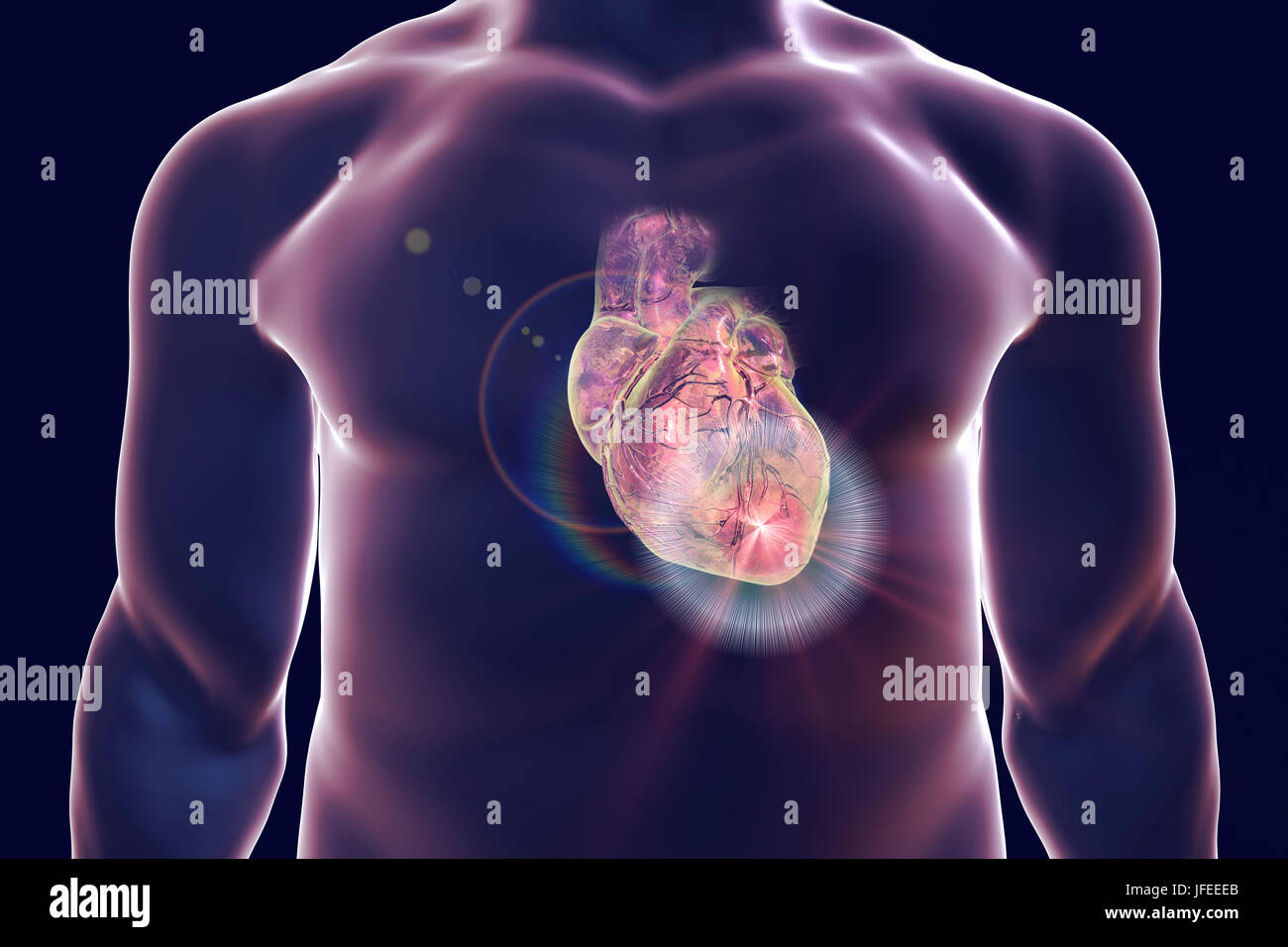 Heart attack, conceptual computer illustration. Stock Photo