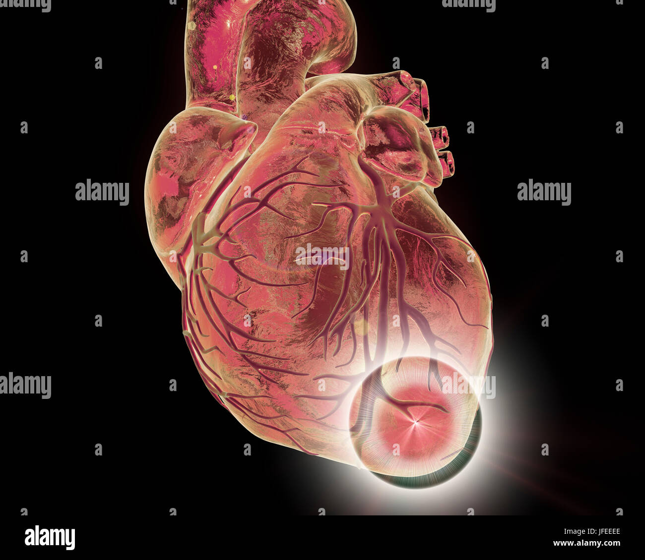 Heart attack, conceptual computer illustration. Stock Photo