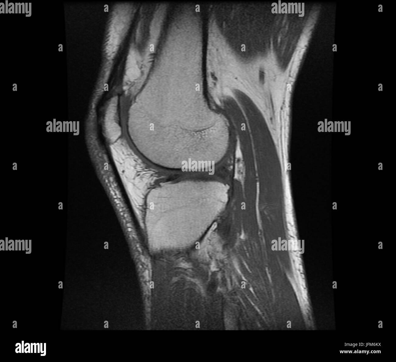 Negative X ray image of human Knee Rheumatism Stock Photo - Alamy