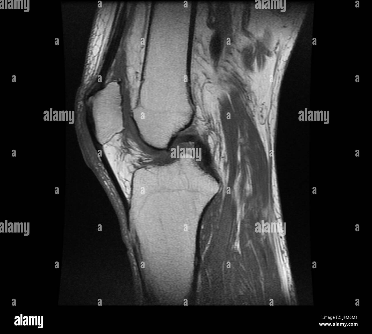 Negative X ray image of human Knee Rheumatism Stock Photo