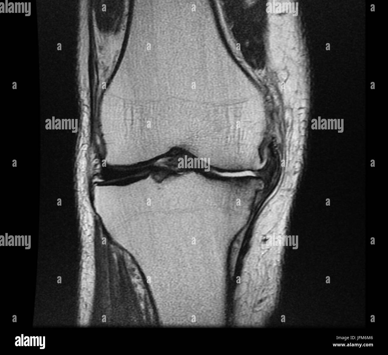 Negative X ray image of human Knee Rheumatism Stock Photo Alamy