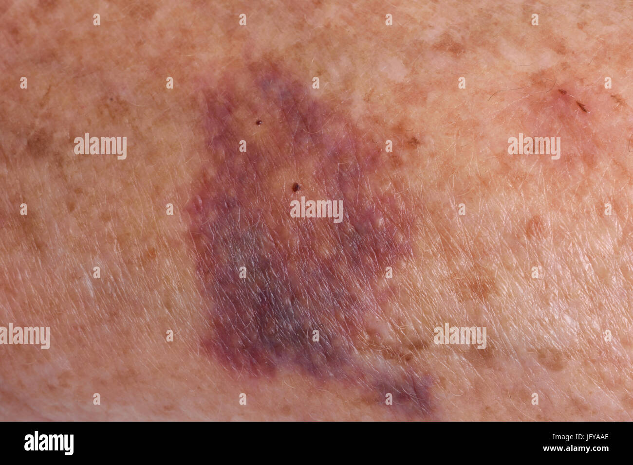 Hematoma Arm Hi-res Stock Photography And Images - Alamy