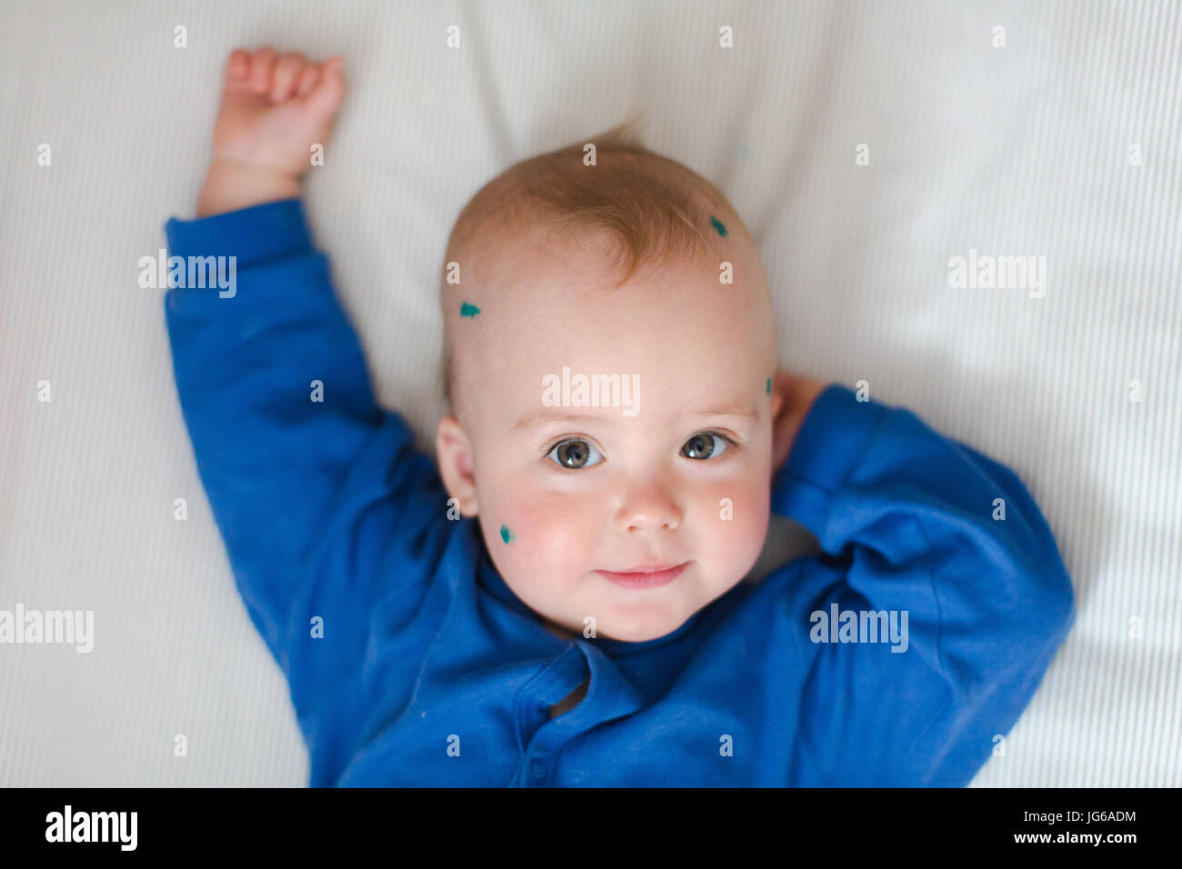 Baby with chickenpox on bed Stock Photo