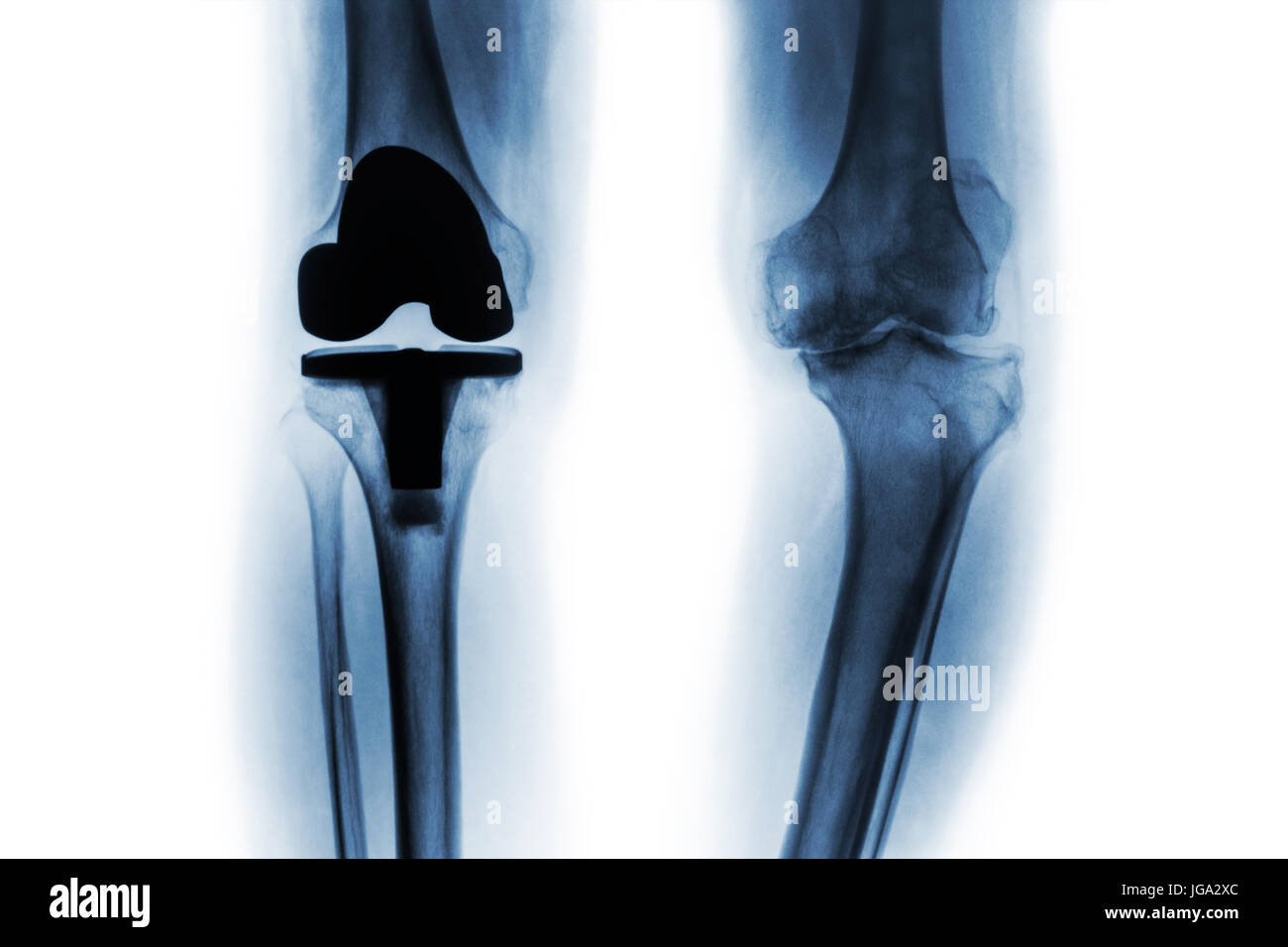 Film x-ray of osteoarthritis knee patient and artificial joint ( Total knee replacement ) . Isolated background . Stock Photo