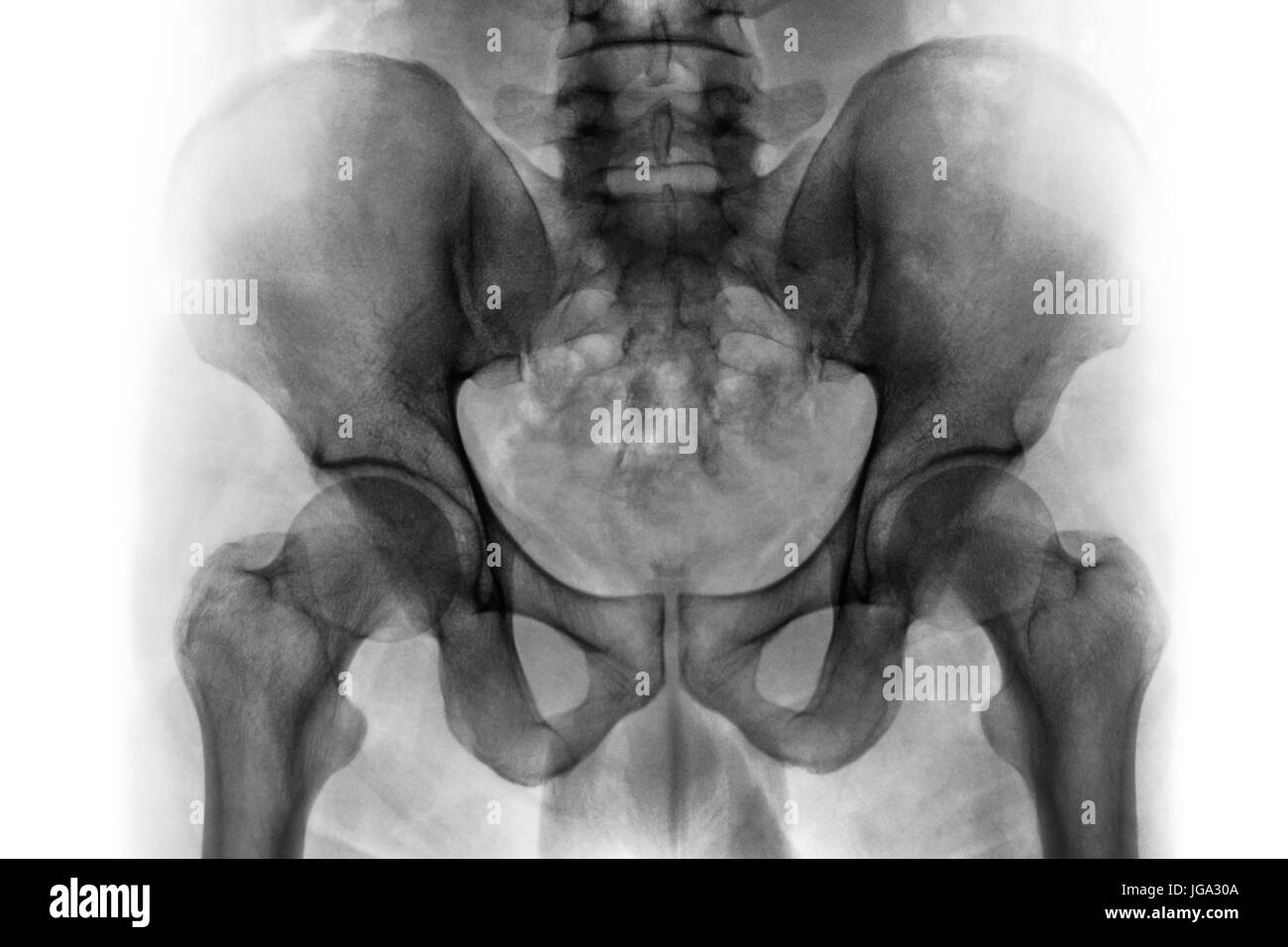 Film x-ray of normal human pelvis and hip joints . Stock Photo