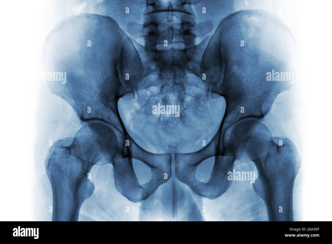 Film x-ray of normal human pelvis and hip joints . Stock Photo