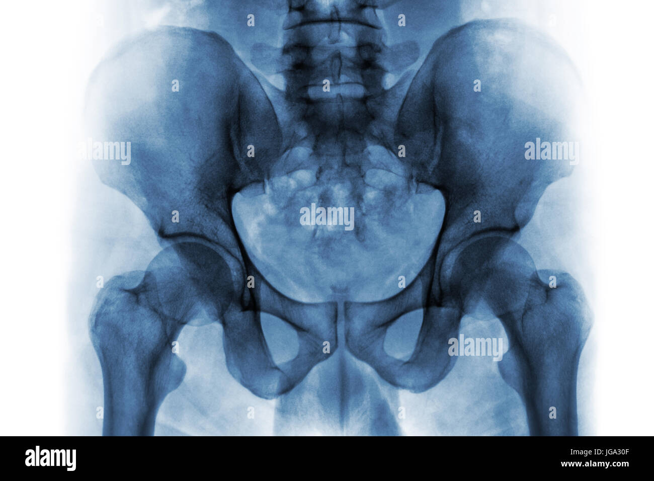 Film x-ray of normal human pelvis and hip joints Stock Photo - Alamy