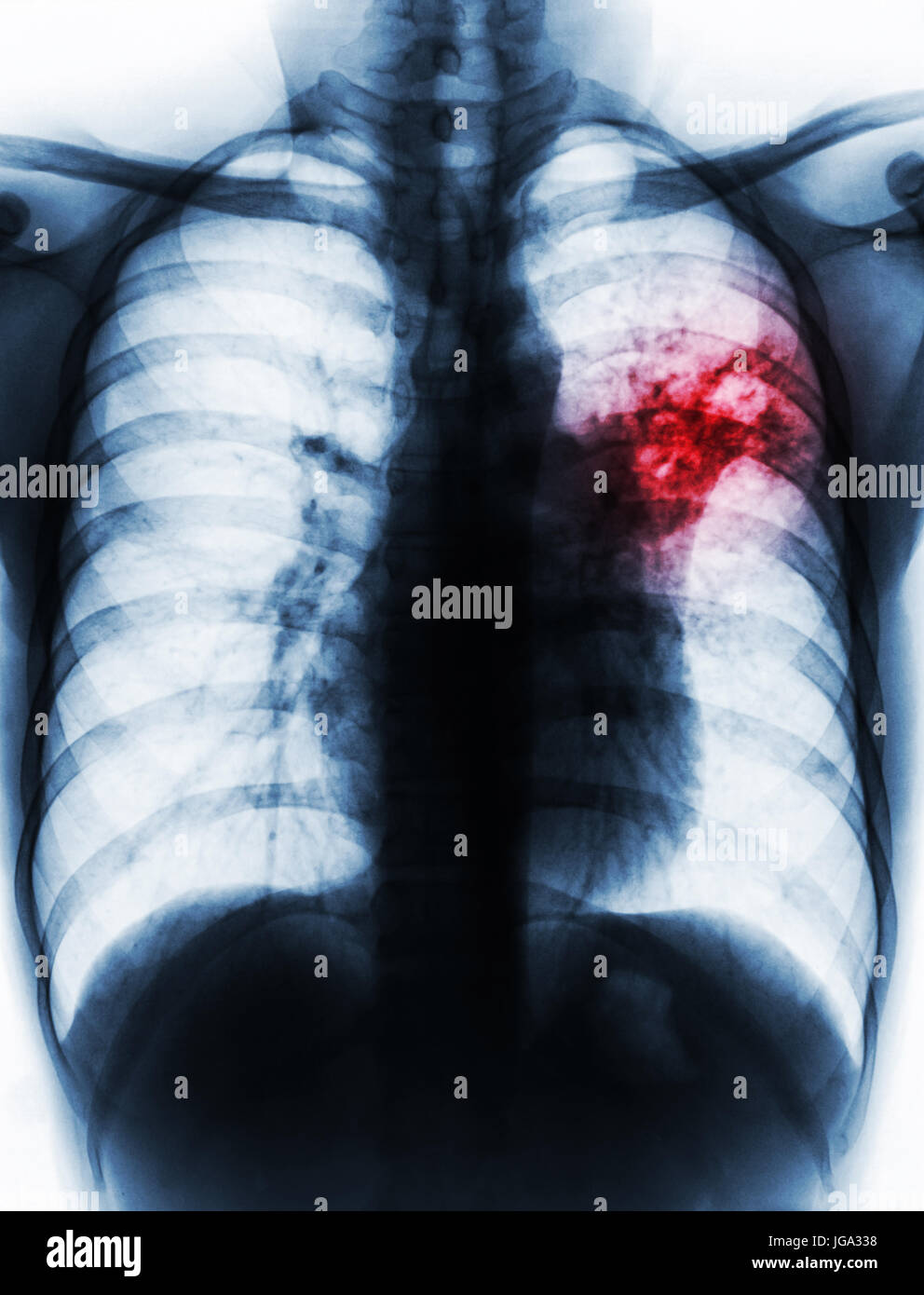 Pulmonary Tuberculosis . Film chest x-ray show alveolar infiltrate at ...