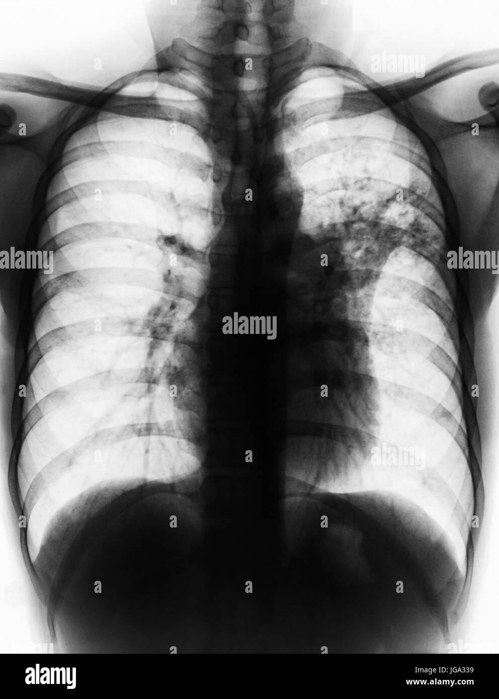 Pulmonary Tuberculosis . Film chest xray show alveolar infiltrate at