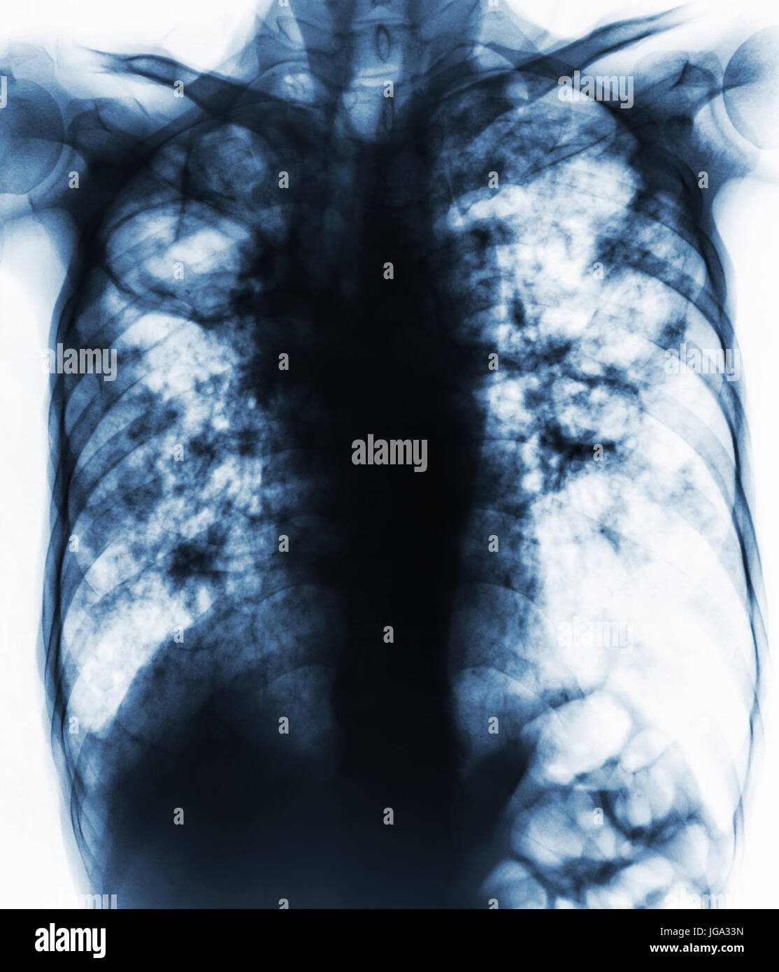 Pulmonary Tuberculosis . Film chest xray show fibrosis,cavity,interstitial infiltration both