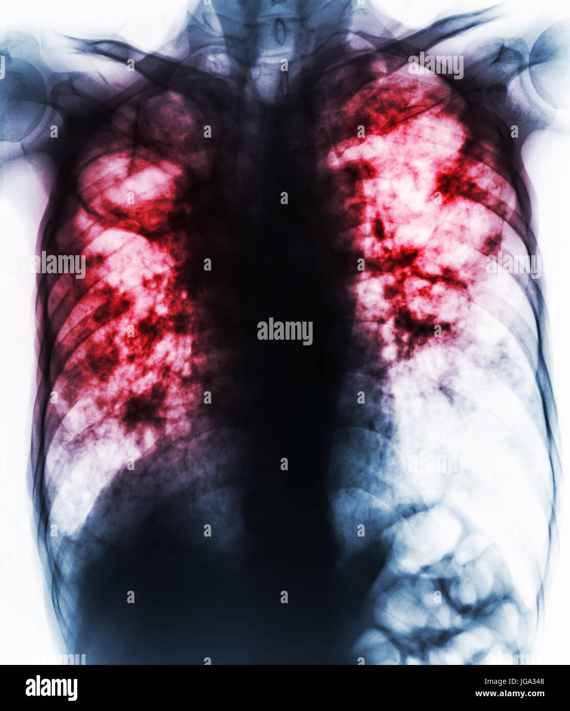 Pulmonary Tuberculosis . Film chest xray show fibrosis,cavity,interstitial infiltration both