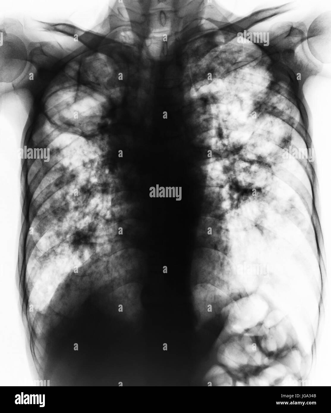 Pulmonary Tuberculosis . Film chest xray show fibrosis,cavity