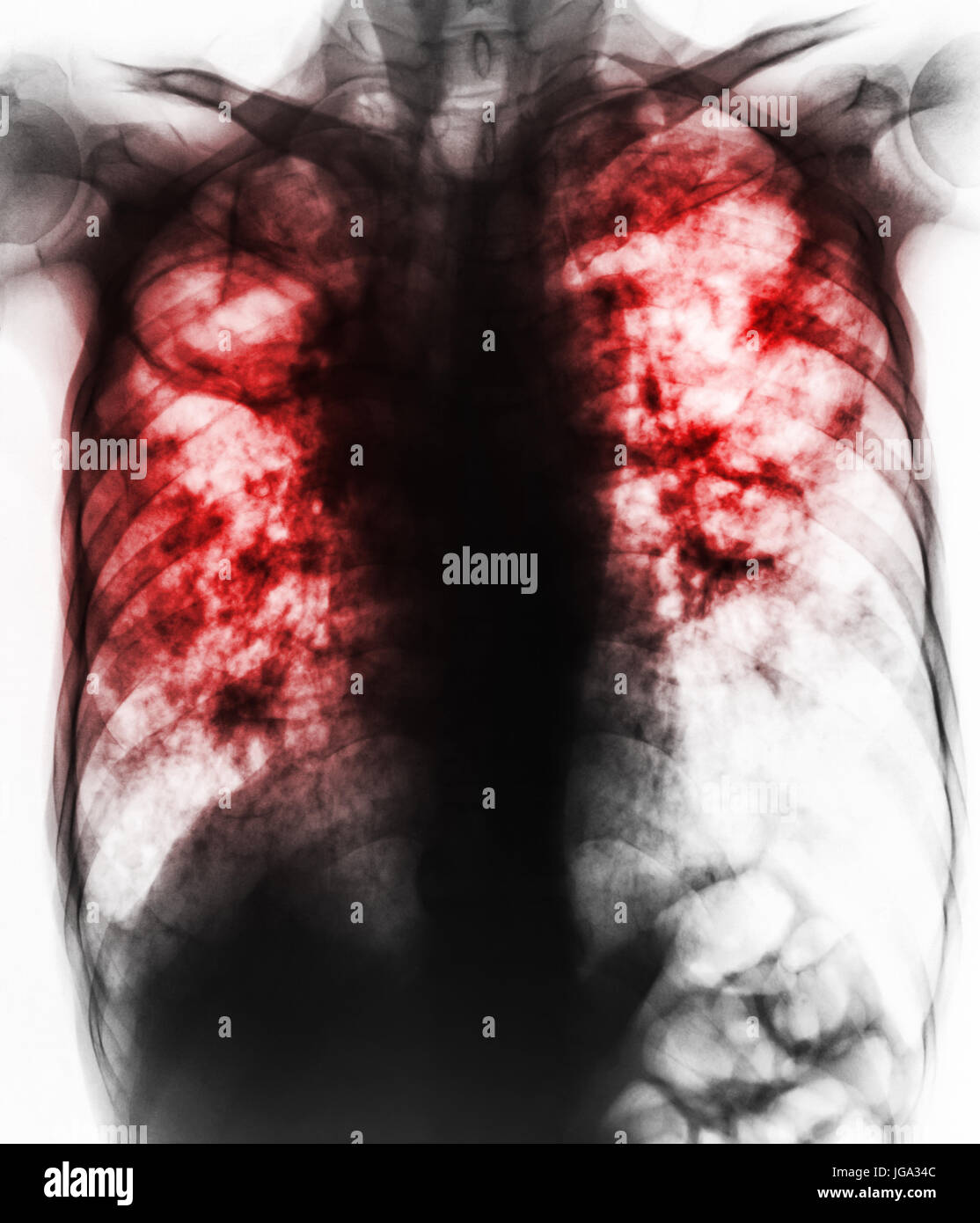 Pulmonary Tuberculosis . Film chest xray show fibrosis,cavity