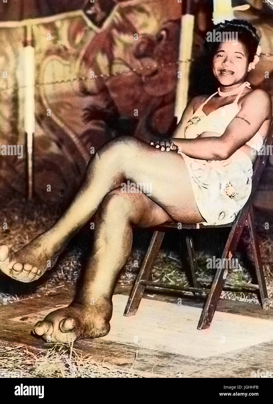 African American sideshow circus entertainer Sylvia Portis, known as Sylvia the Elephant Girl, smiling and displaying her feet, which are deformed and show signs of the disease elephantiasis, 1944. Note: Image has been digitally colorized using a modern process. Colors may not be period-accurate. Stock Photo