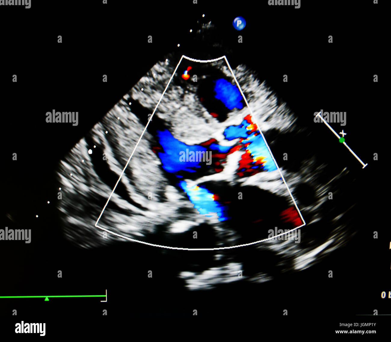 Flow color mode show jet from aortic and mitral valve regurgitation Stock Photo