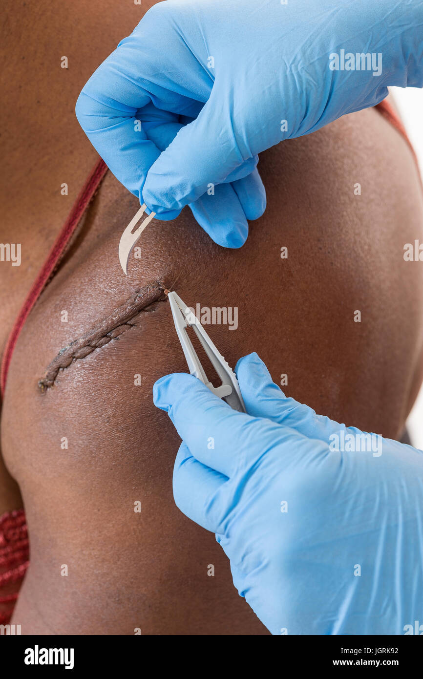 gloved hands Removing medical thread from wound with stitches on woam blaclk skin shoulder with medical equipment, Stock Photo