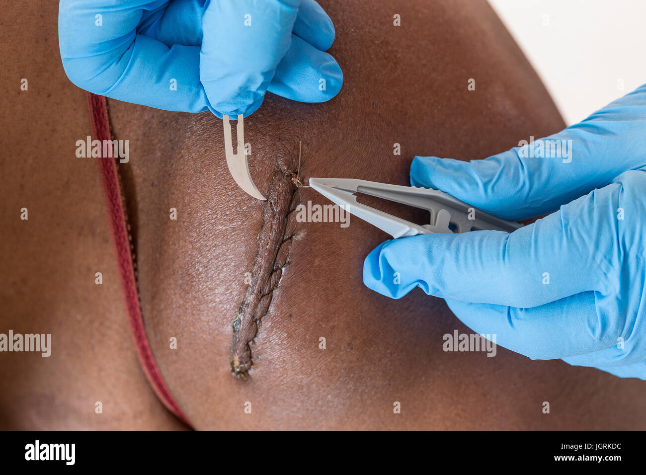 gloved hands Removing medical thread from wound with stitches on woam blaclk skin shoulder with medical equipment, Stock Photo
