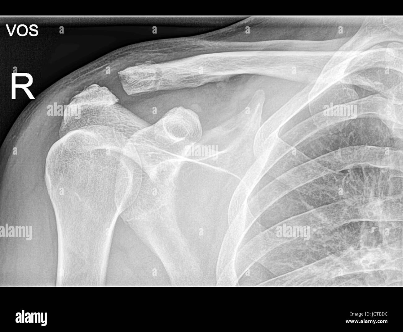Broken clavicle bone, Shoulder Medical Xray, Patient treatment Stock