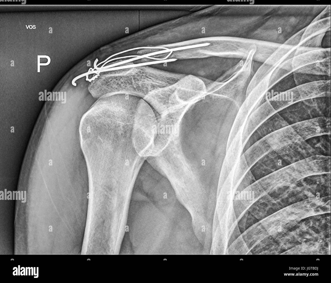 Broken clavicle bone, Shoulder Medical Xray, Patient treatment Stock